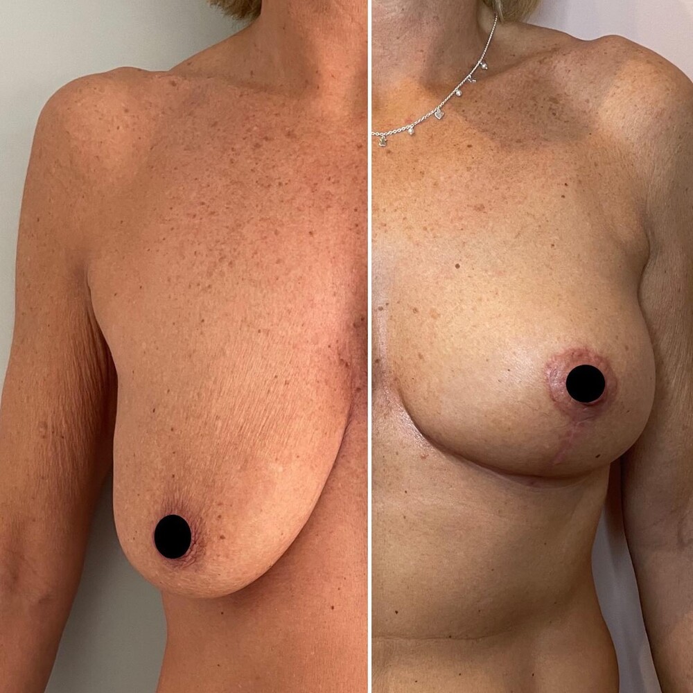 Before and After Result